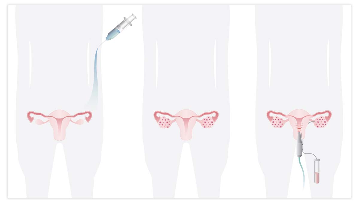 Ovarian hyperstimulation